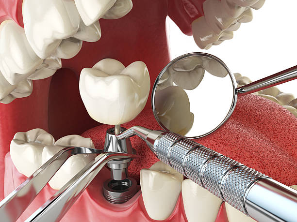 Best Dental Abscess Treatment in Franklin, NH